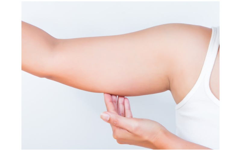 Yếu tố di truyền cũng có thể khiến bắp tay bị béo