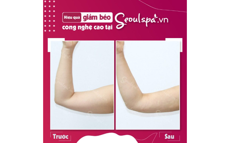 Hình ảnh khách hàng trước và sau khi thực hiện thu gọn bắp tay tại SeoulSpa.vn