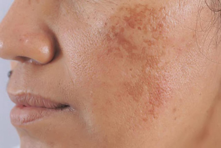 Nám da là một trong những vấn đề về da thường gặp ở rất nhiều chị em