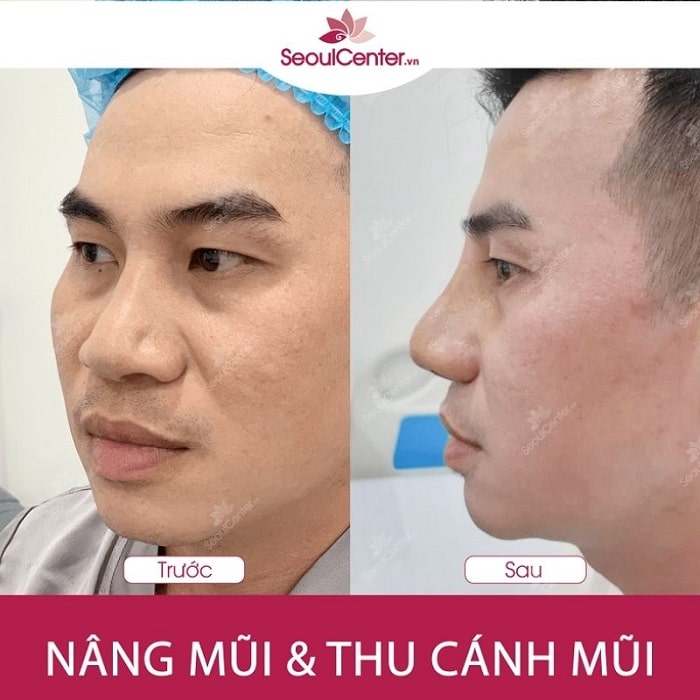 Hình ảnh anh Lâm trước và sau khi nâng mũi và thu cánh mũi do BS. Phạm Thanh Hào