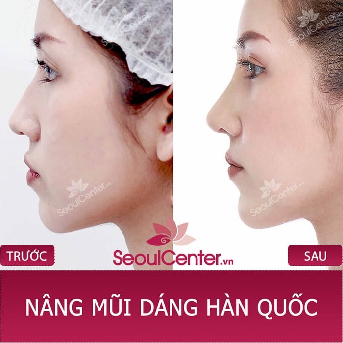 Chị Lê Qúy Vân sử dụng nâng mũi do BS. Phạm Thanh Hào thực hiện