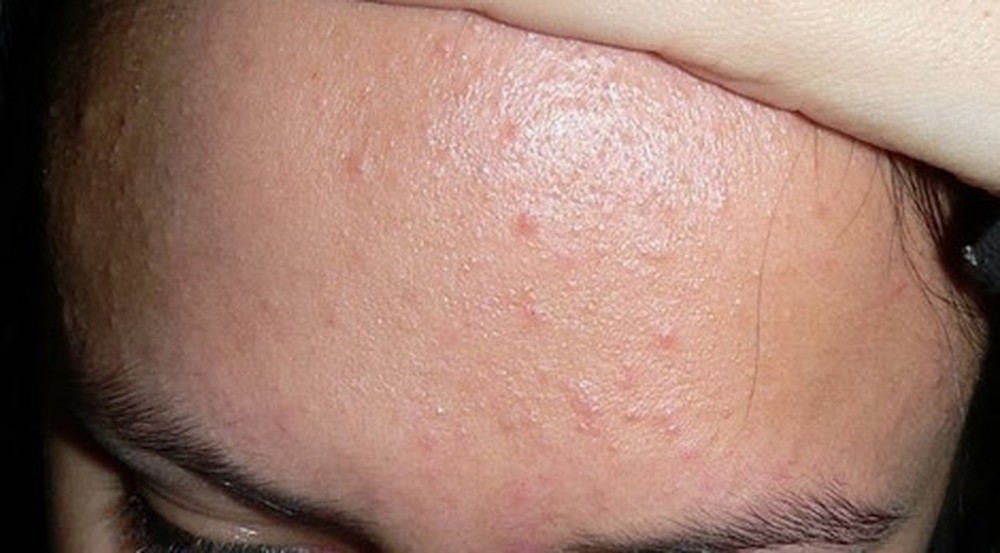 Mụn ẩn dưới da thường mọc nhiều ở trán
