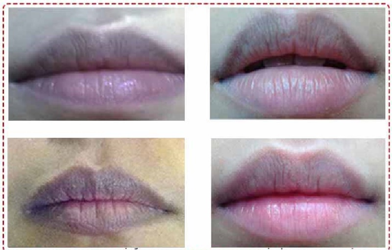 Thâm môi là tình trạng gặp phải ở nhiều người