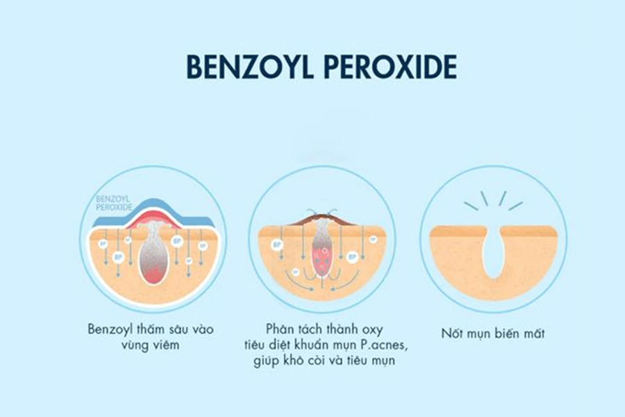 Cách làm với Benzoyl Peroxide
