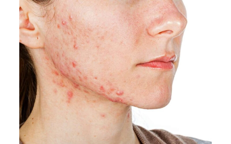 Cạo lông mặt khiến da mất đi khả năng đề kháng và dễ kích ứng