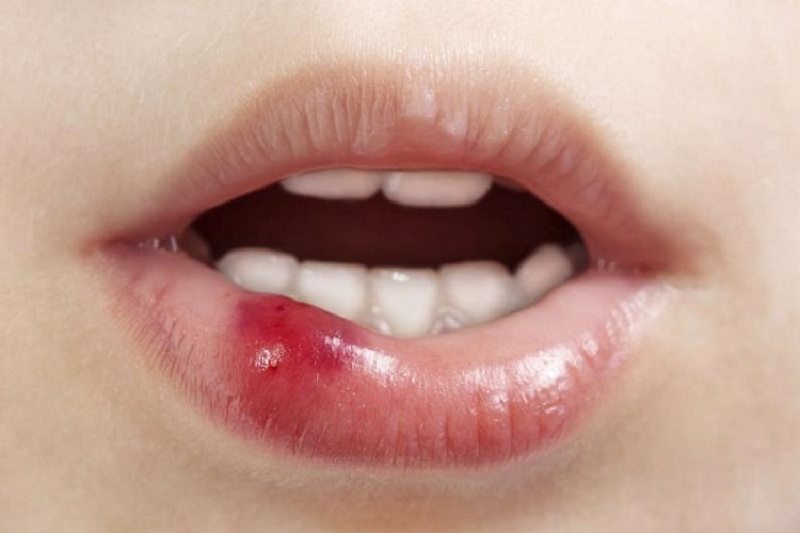 Nhiệt miệng là hiện tượng dễ thấy ở nhiều người gây mụn, loét trên môi