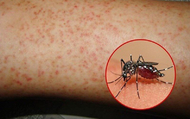Khi bị muỗi cắn sẽ để lại những vết mẩn đỏ gây nên cảm giác ngứa khó chịu