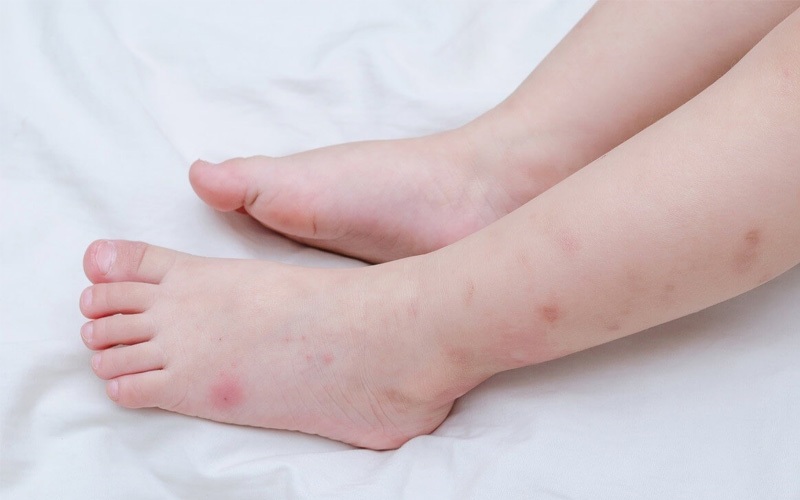 Vết thâm muỗi đốt khiến nhiều bé khó chịu