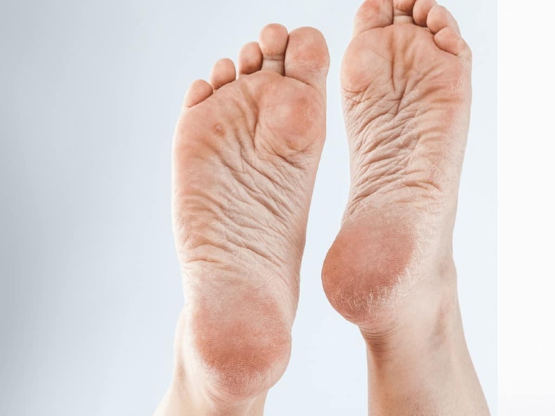Nứt gót chân được hình thành từ rất nhiều nguyên nhân, khiến bạn cảm thấy vô cùng phiền toái, khó chịu và đau nhức