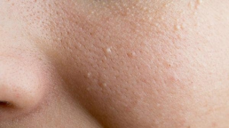                     Da mặt bị nổi mụn nước là do dị ứng bởi mỹ phẩm