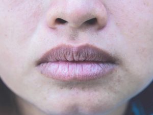 Chế độ chăm sóc không kỹ lưỡng có thể khiến phun môi bị hỏng