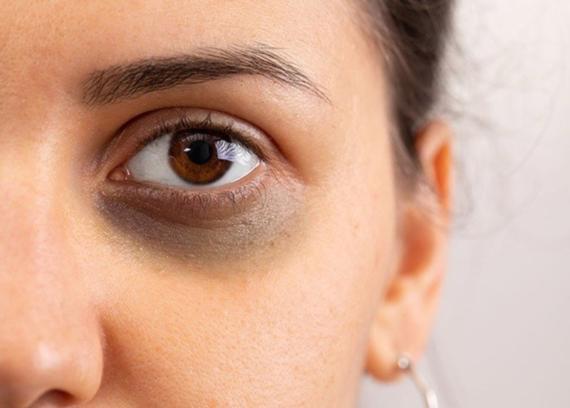 Nguyên nhân làm cho vùng da xung quanh mắt xuất hiện quầng thâm