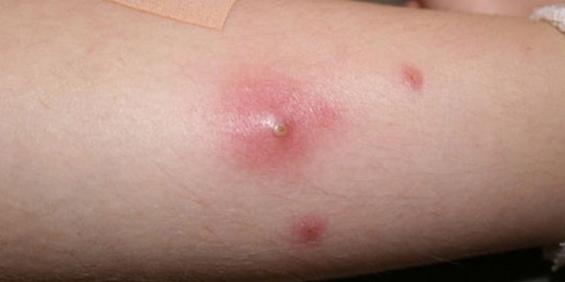 Mụn nhọt là loại bệnh da liễu phổ biến tạo nên từ các nốt mẩn đỏ trên da