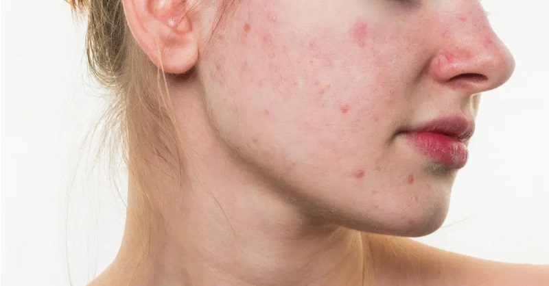 Mụn viêm rất dễ nhận biết vì nó là các nốt trắng có mủ xuất hiện trên da mặt hoặc cổ