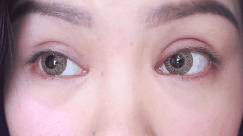 Những dấu hiệu có thể gặp khi mắt bị trợn