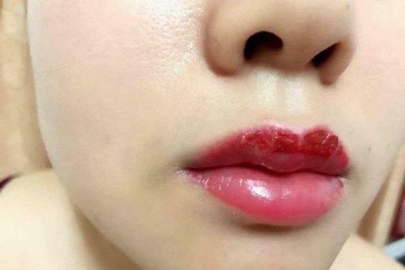 Hôn môi sau khi phun có thể gây ra tổn thương cho đôi môi
